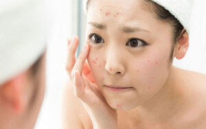 Nặn mụn sai cách khiến tình trạng mụn càng trở nên trầm trọng