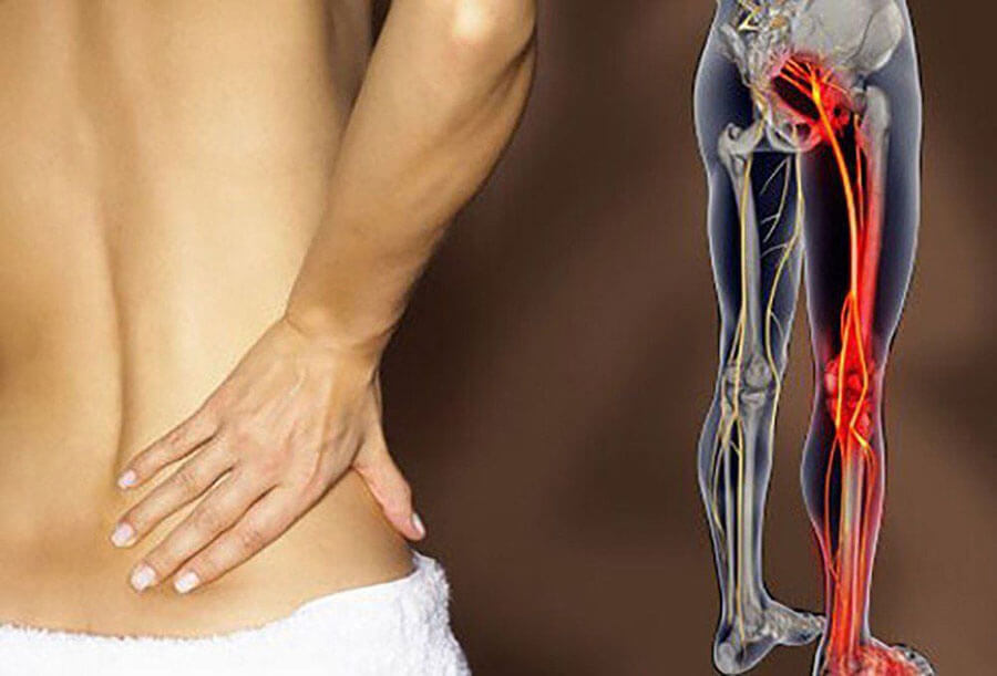 4 Cách Chữa Đau Lưng Bằng Thuốc Nam Có Sẵn Trong Vườn Nhà, Đánh Bay Tê Bì, Nhức Mỏi 3 Đau thần kinh tọa rất khó phát hiện tình trạng bệnh