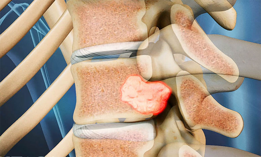 4 Cách Chữa Đau Lưng Bằng Thuốc Nam Có Sẵn Trong Vườn Nhà, Đánh Bay Tê Bì, Nhức Mỏi 4 Đau lưng sẽ khiến người bệnh bị hạn chế khi vận động và di chuyển